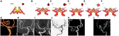 Classification of anatomy and treatment approaches for aneurysms originating from the proximal of the A1 segment of the anterior cerebral artery in clinical settings